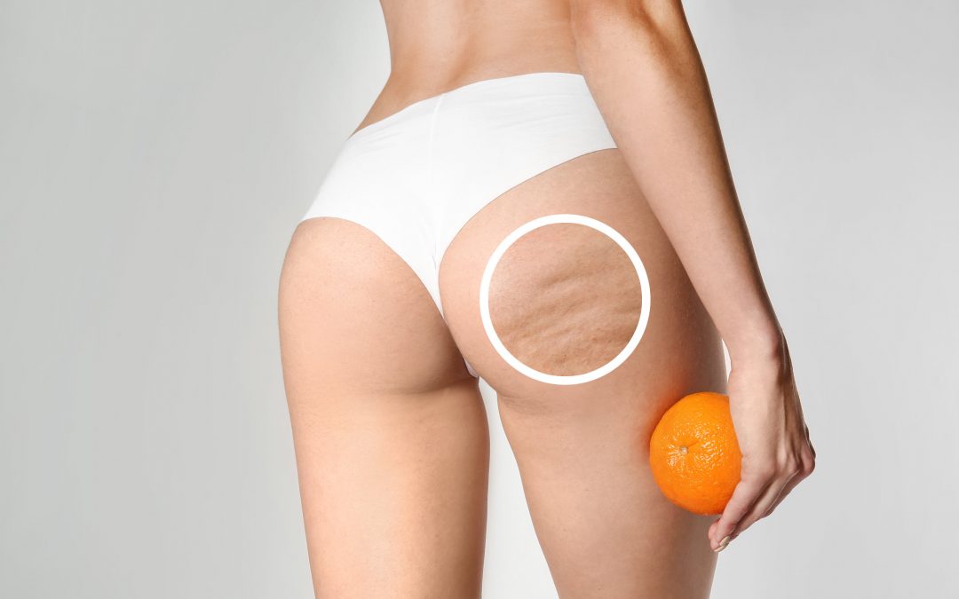 Cellulite Behandlung: Ursachen, Erscheinungsbilder & effektiv bekämpfen